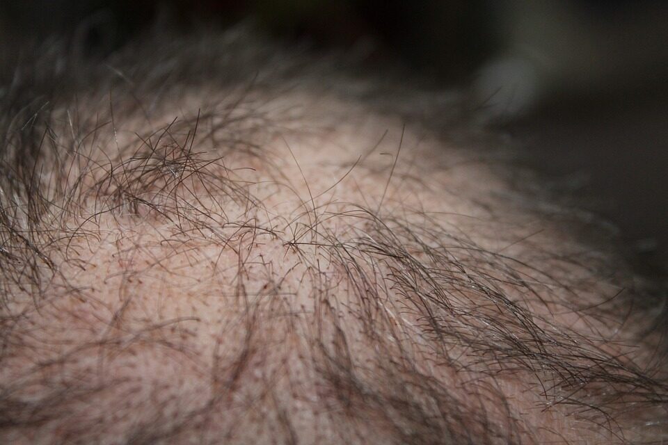 alopecia