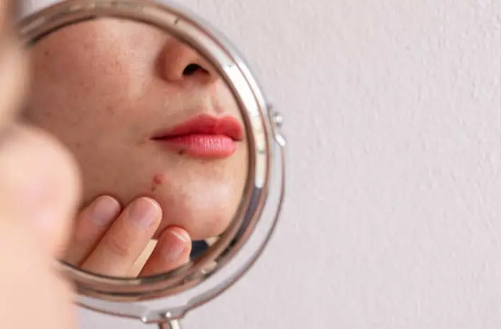 Cicatrizes de espinhas desaparecem Encontre o melhor creme para remoção de cicatrizes para o seu tipo de pele