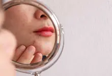 Pimple Scars Be Gone Trouvez la meilleure crème anti-cicatrices pour votre type de peau